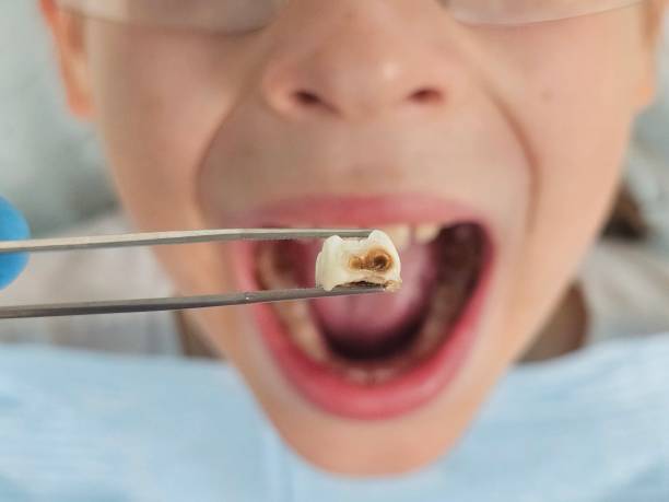 Best Broken or Chipped Tooth Repair in Gholson, TX